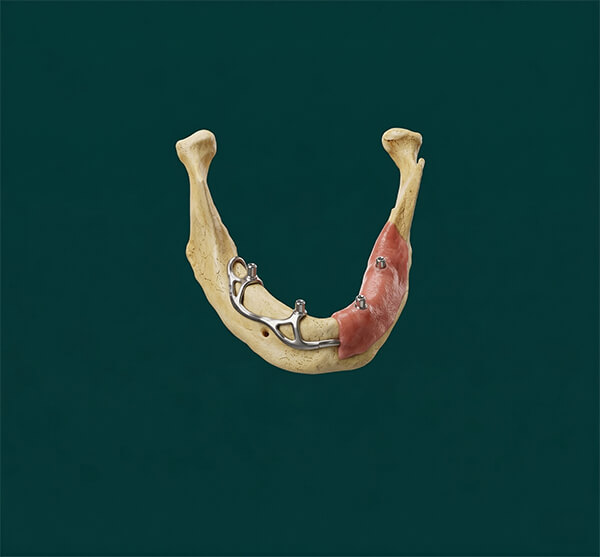 Custom Implants