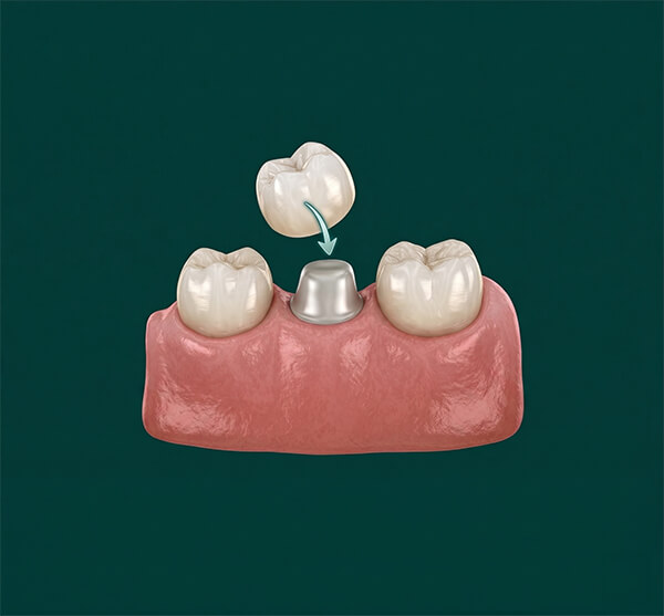 Dental Crowns