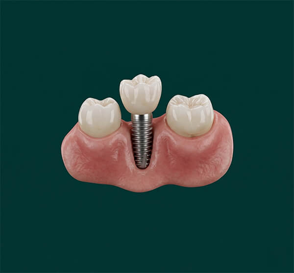 Dental Implant