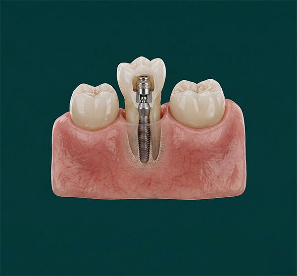 Mini Implants