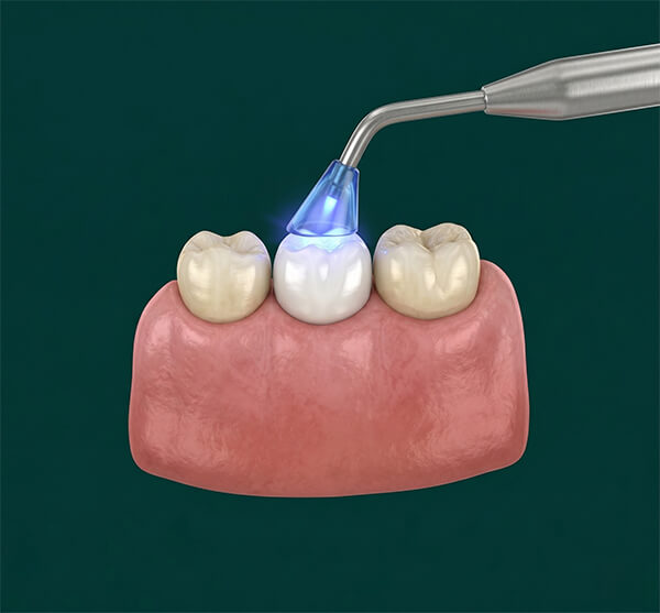 Teeth Whitening