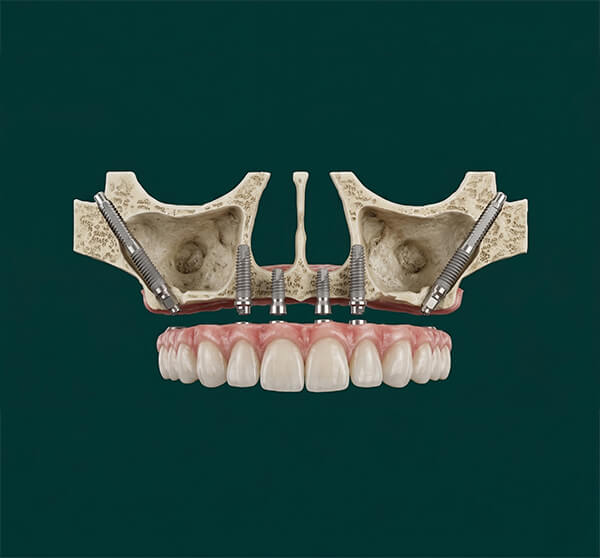 Zygoma Implants