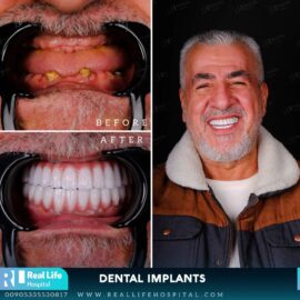 dental implants 14