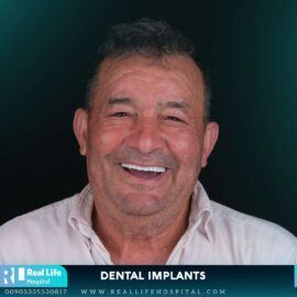 dental implants 23