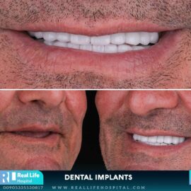 dental implants 233
