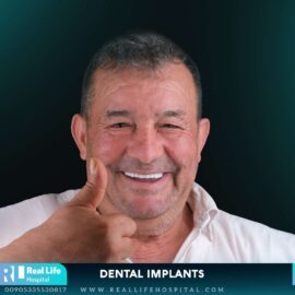 dental implants 236
