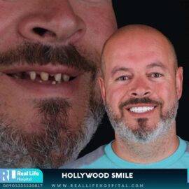 dental implants 23612