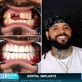 dental implants 27
