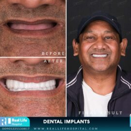 dental implants 46