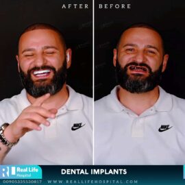 dental implants 46