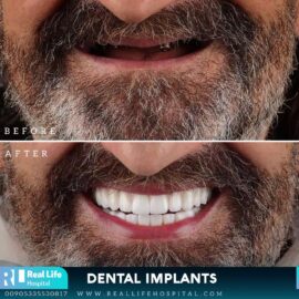 dental implants 49