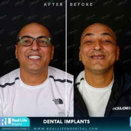 dental implants 52