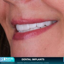 dental implants 64969872