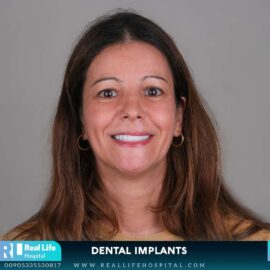 dental implants 649698723