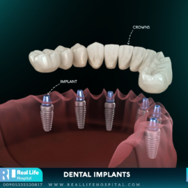 dental implants 6497