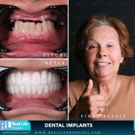 dental implants 97