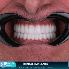 dental implants 9746132
