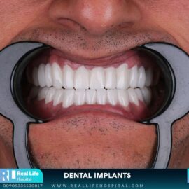 dental implants 97461391