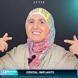 dental implants real life 4647544