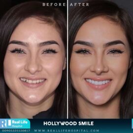 hollywood smile 19493
