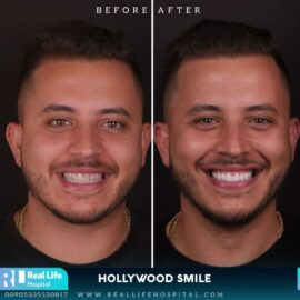 hollywood smile 1949394