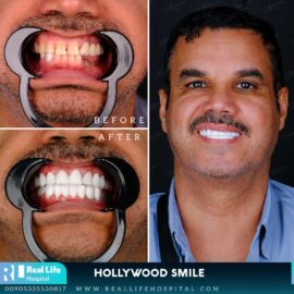 hollywood smile 2