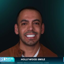 hollywood smile 260