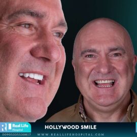 hollywood smile 26021
