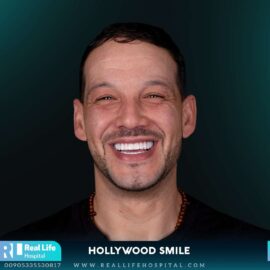 hollywood smile 2604