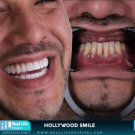 hollywood smile 26043