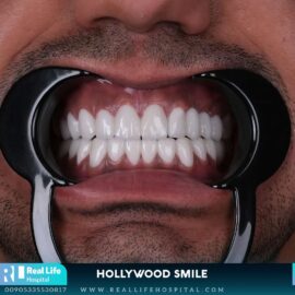 hollywood smile 26121