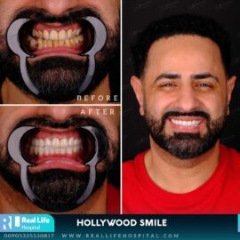 hollywood smile