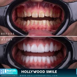 hollywood smile 3669