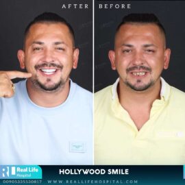 hollywood smile 49