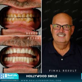 hollywood smile 648
