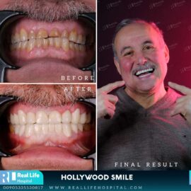 hollywood smile 6488