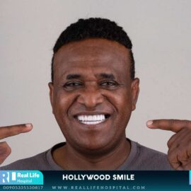 hollywood smile 69