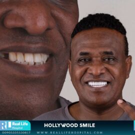 hollywood smile 692