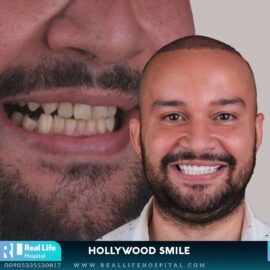 hollywood smile 6922