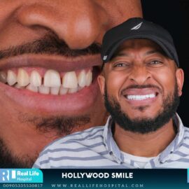 hollywood smile 69223