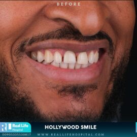 hollywood smile 692231