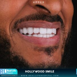 hollywood smile 6922313
