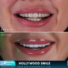 hollywood smile 912