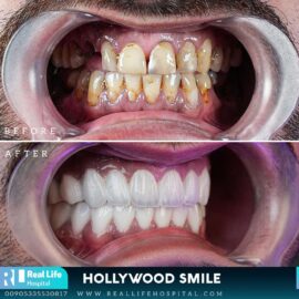 hollywood smile 9121