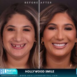 hollywood smile 91214196