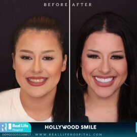 hollywood smile 9121419646