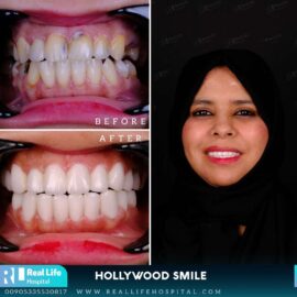hollywood smile5645
