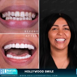 hollywood smile5648